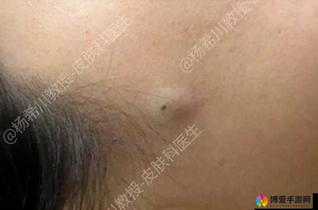 女性三角毛毛区长了个硬疙瘩：这到底是怎么回事应如何应对