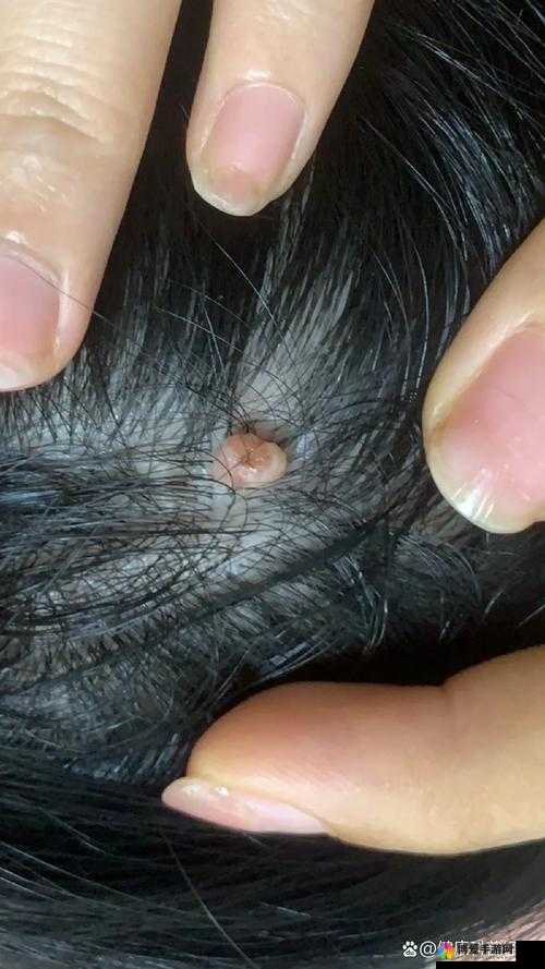 女性尿道口用手摸有一个疙瘩，是怎么回事？